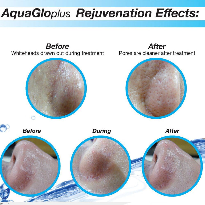 AquaGlo Plus™ Abrasion-Free Hydra Peeling Liquid Facial System with Cryo-Chill Handpieceby Sybaritic